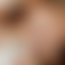 Upper Eyelid Surgery: Blepharoplasty Explained