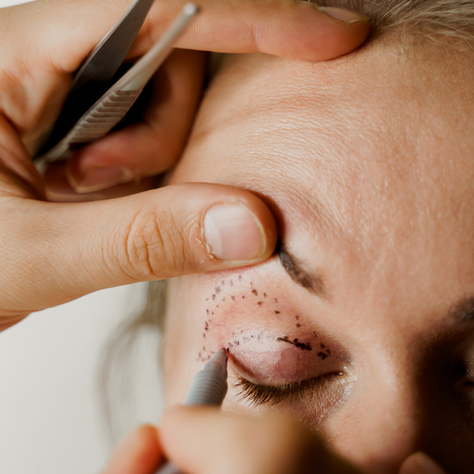 Upper Eyelid Surgery: Blepharoplasty Explained
