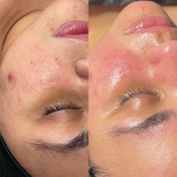 Dull skin + hormonal Acne