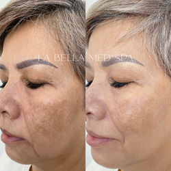 Melasma