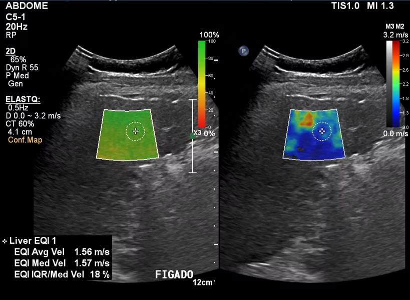 Elastografia Hepática