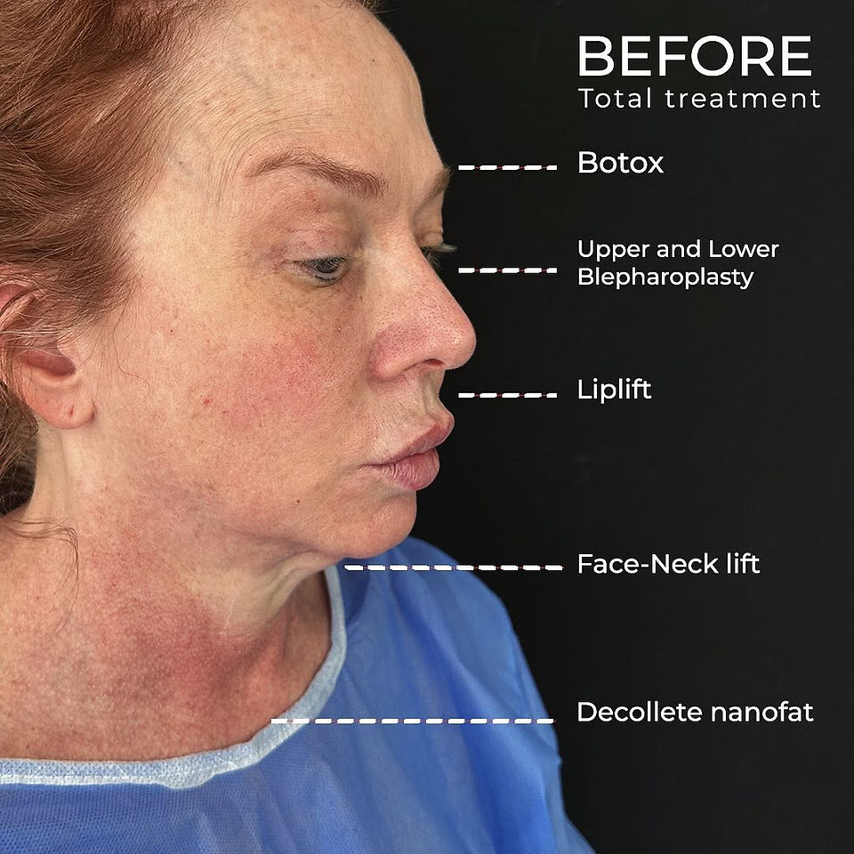  Before photo of face neck lift temporal lift patient 