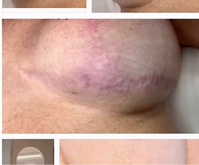 Breast reduction anchor scar with red and purple color during healing