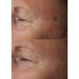Resultaat, before/after, microneedling - rimpels bij het oog