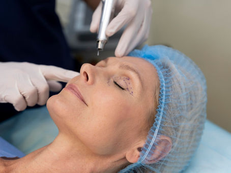 Conheça a Blefaroplastia a Laser CO2, novo procedimento realizado pela Dra. Andreia Laranjeira