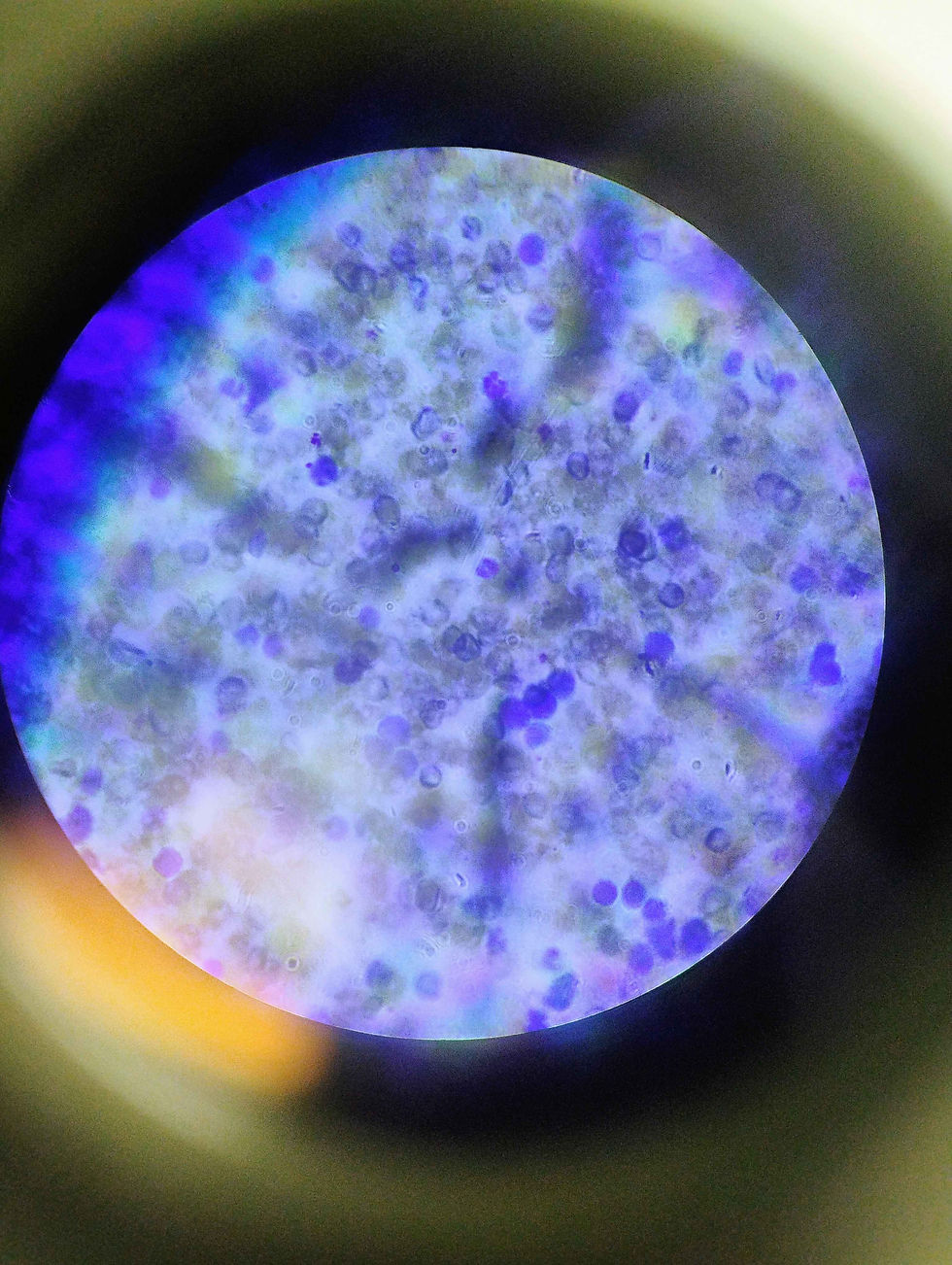 Cancerous Mammary Cells