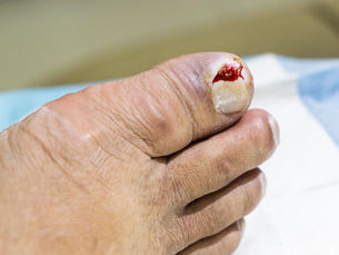 Ingrown toenails can be a right pain…