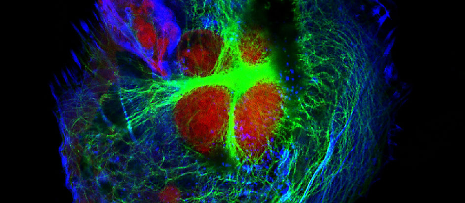Alzheimer’s Scrambles the Metabolism-sleep Connection
