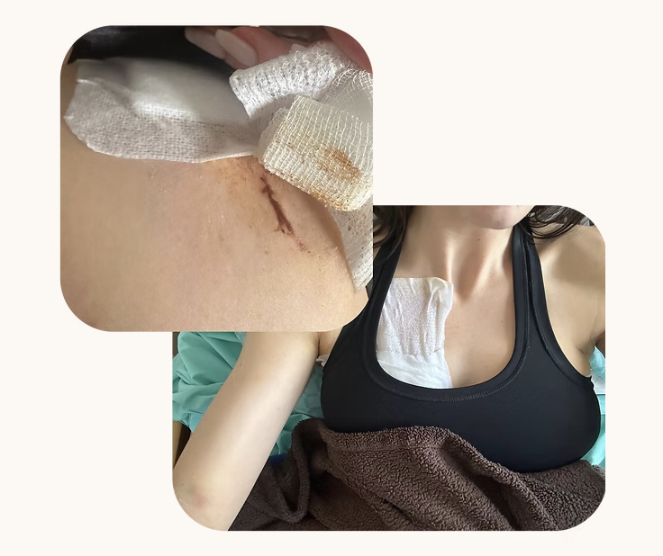 Two photos taken after surgery in 2024: a stitched incision and a dressing on the chest