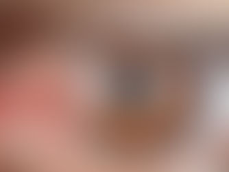 ¿Cuándo operar un Pterigion o Carnosidad del ojo?