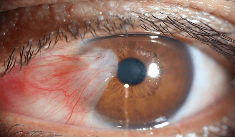 ¿Cuándo operar un Pterigion o Carnosidad del ojo?