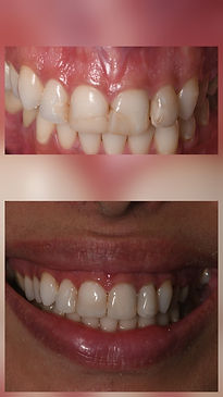 reconstruction des dents avec un composite stratifié 