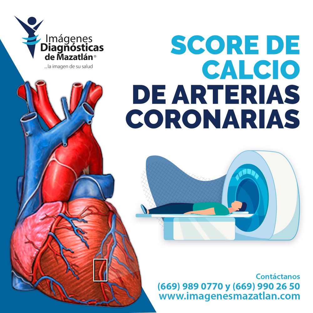 SCORE DE CALCIO DE ARTERIAS CORONARIAS