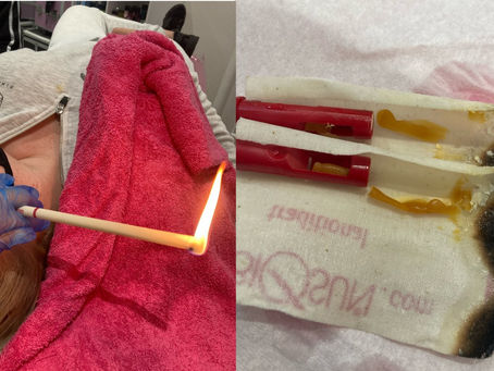 Thermal auricular therapy