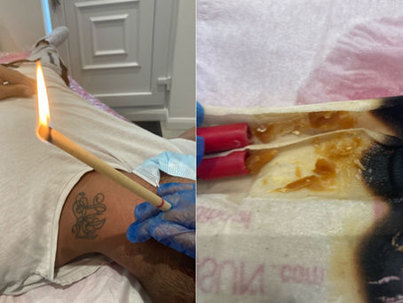 Thermal auricular therapy hopi ear candling