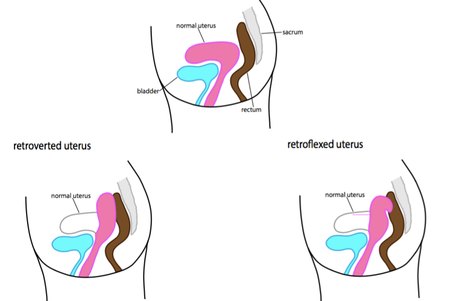 Uterus Positions. Copyright Rachel Eyre. All Rights Reserved