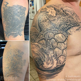 Détatouage laser avant un nouveau tatouage - 