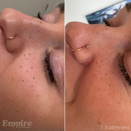 Détatouage des taches de rousseur - Détatouage laser des pigments cosmétiques - Empire Détatouage Quebec 