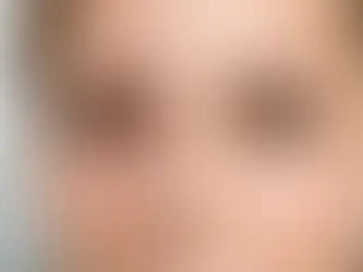 Dry Eye Treatment Before After Results