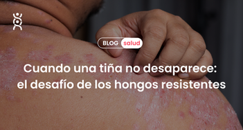 Cuando una tiña no desaparece: el desafío de los hongos resistentes