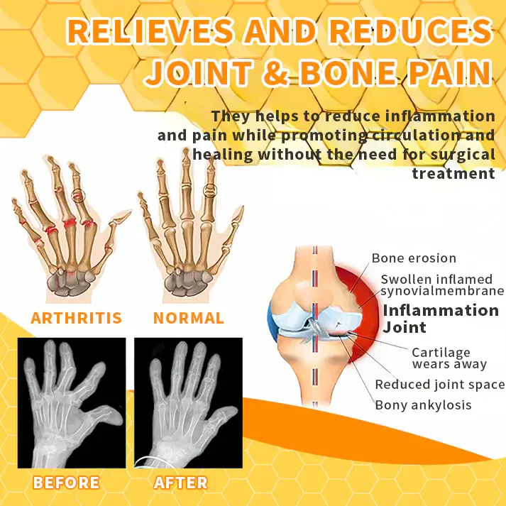 Thumbnail: TAILEDEN™ Bee Venom Joint Therapy Pain Relief Gel