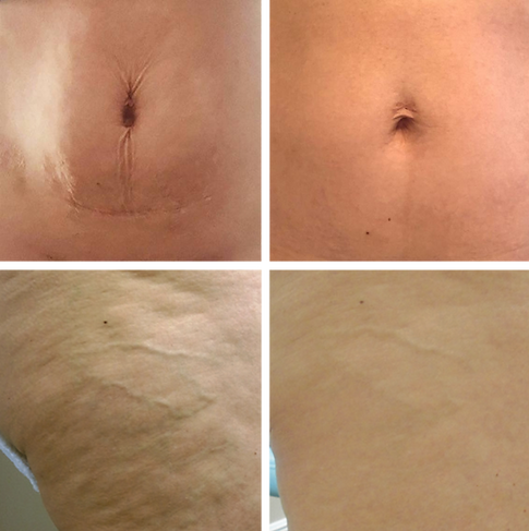 Stomach Skin Tightening Sudbury