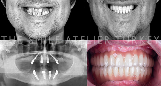 all on four dental implant