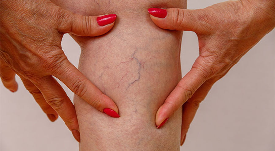 what-are-varicose-veins_header.jpeg