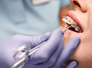 Top 10 Things to Know Before Getting Braces