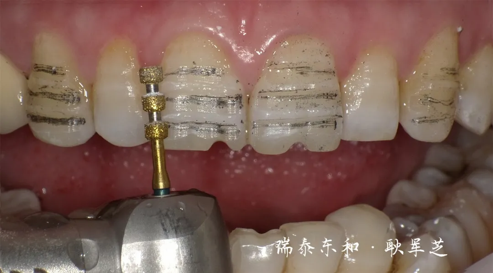 全锆贴面时代已经到来!