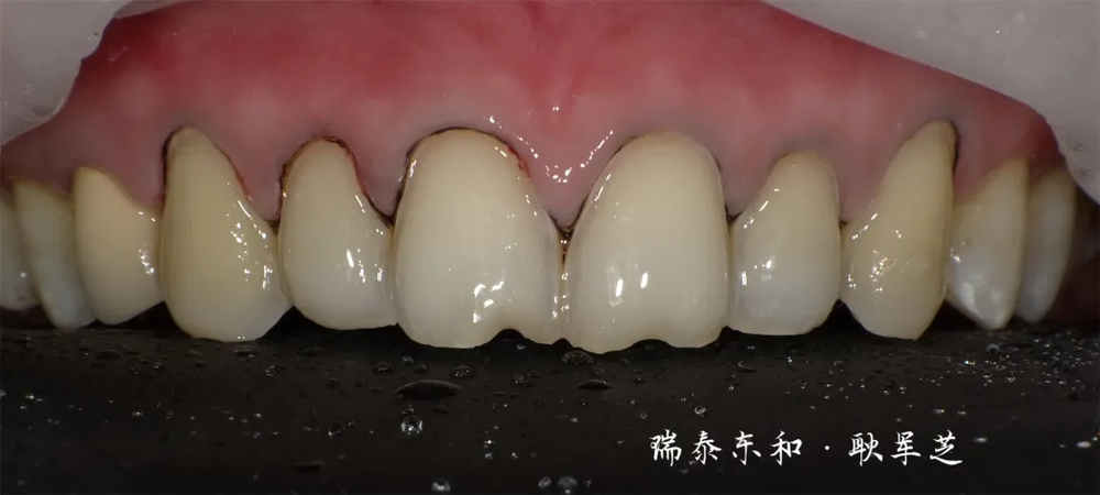 全锆贴面时代已经到来!