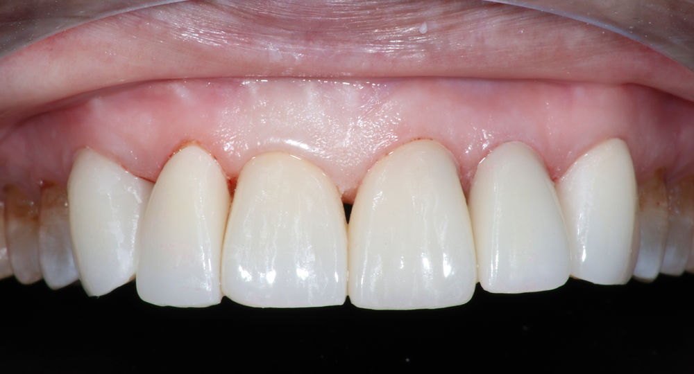 爱迪特百奥美氧化锆贴面病例赏析