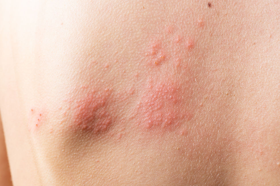 Shingles Vaccine in Thame, Oxford – Who Needs It and How to Get Protected