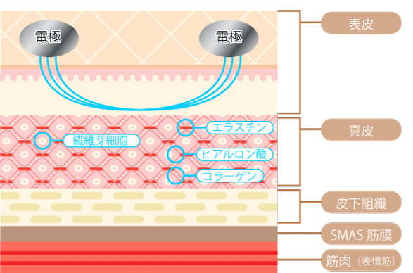 中間市のセルフ脱毛サロン アップビューティー 小顔マシンGIF