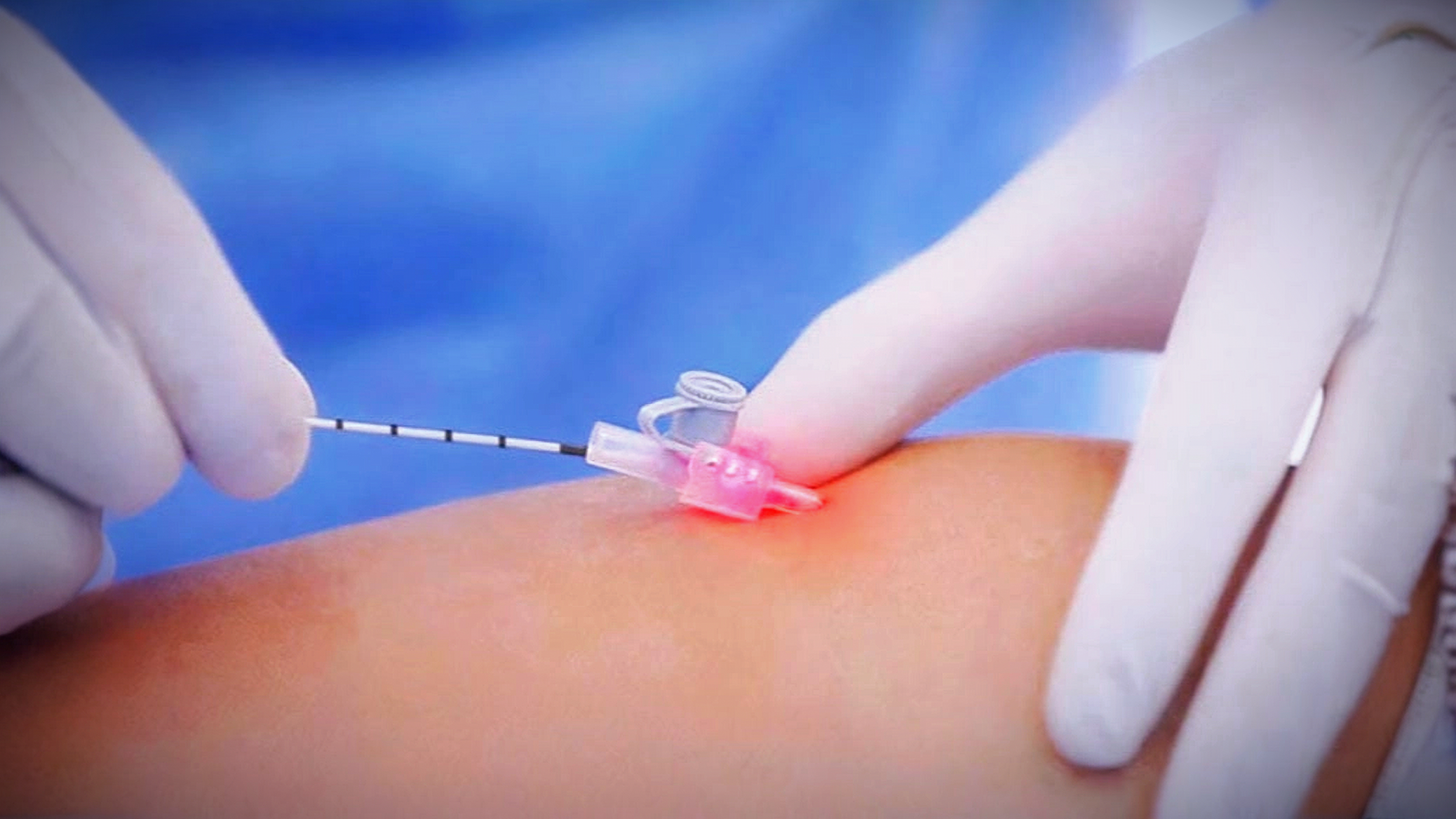 laser endovenoso, conhecido como endolaser no tratamento de varizes de membros inferiores .