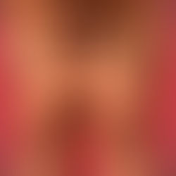 O que é Lipedema? Entenda a Condição e Seus Tratamentos