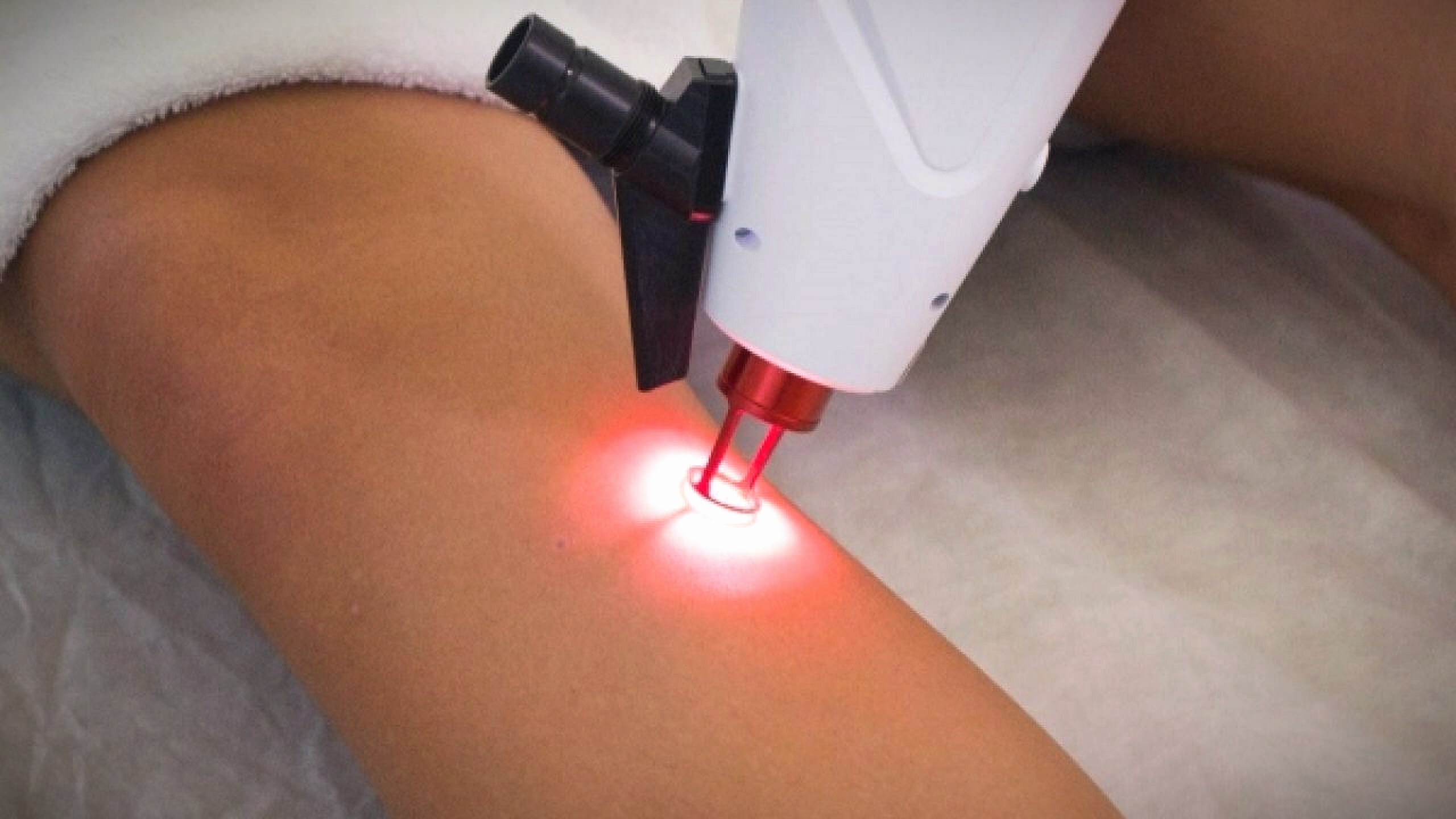 laser, laser transdermico no tratamento de varizes de membros inferiores
