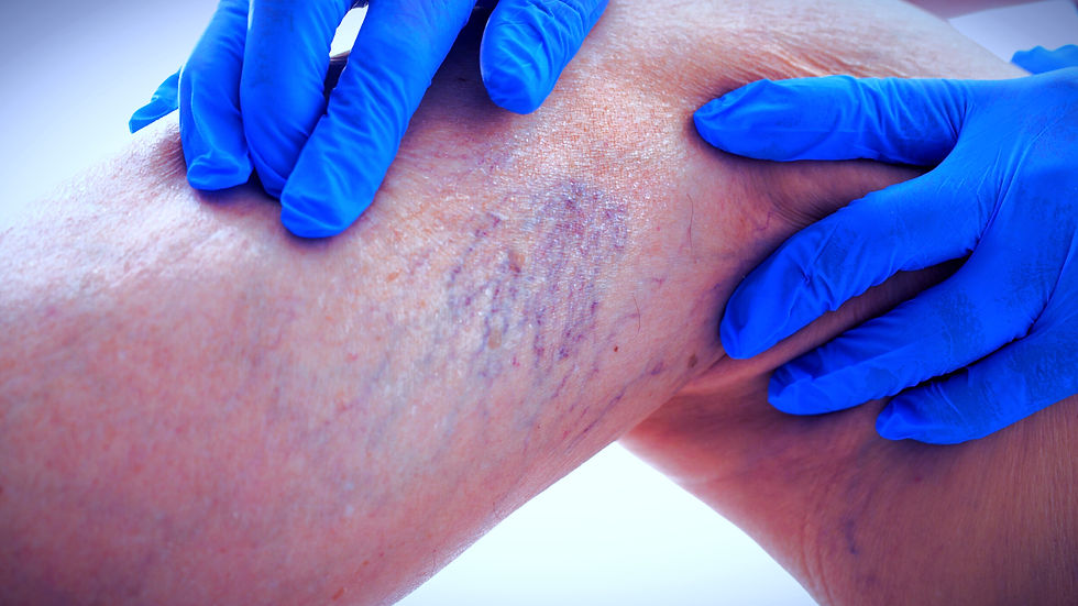 O que leva a pessoa a ter varizes, sinais de alerta de varizes