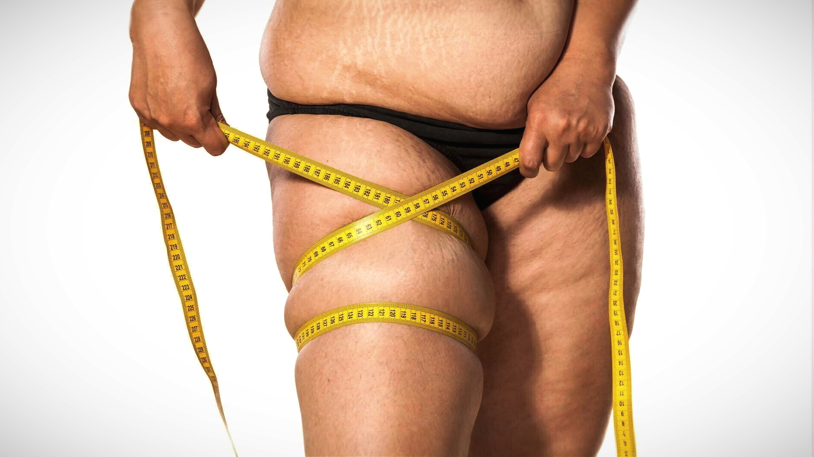 tratamento de lipedema, qualidade de vida