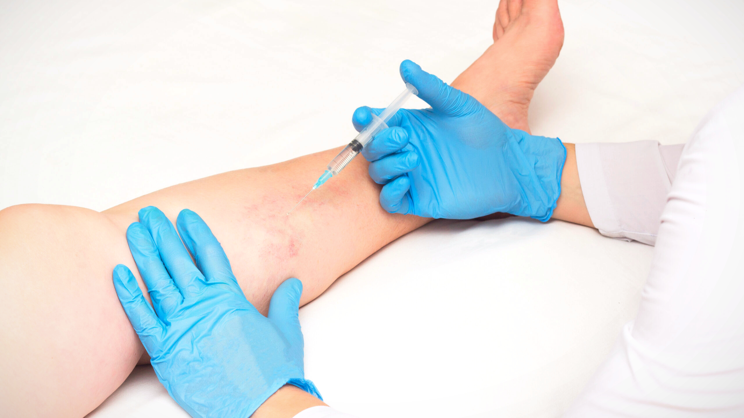 como é a aplicação secagem de vasinhos teleangectaisias varizes spider veins