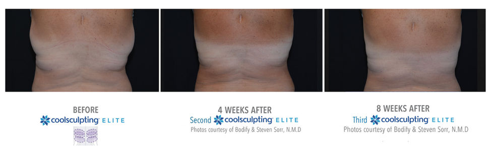 bra line coolsculpting results