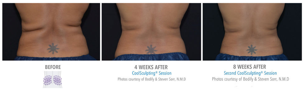 love handles coolsculpting before and after