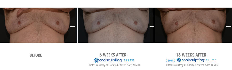 coolsculpting pecs before and after 