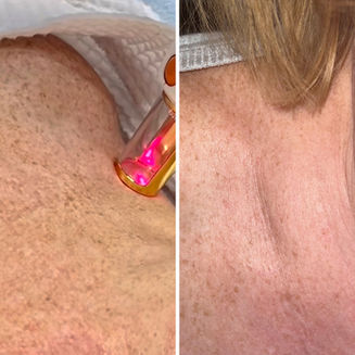 laser treatment before and after results