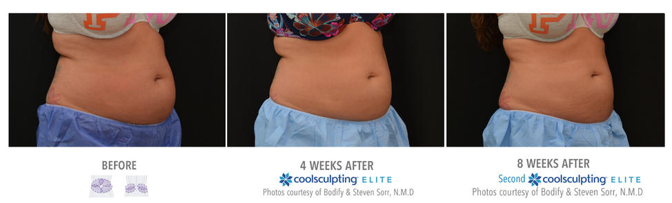 coolsculpting treatment upper abs