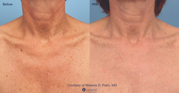 laser treatment before and after results