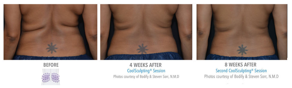 love handles coolsculpting before and after