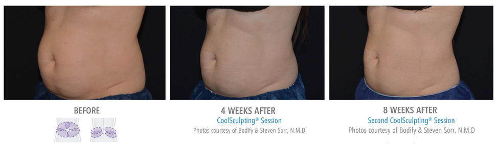 coolsculpting treatment upper abs