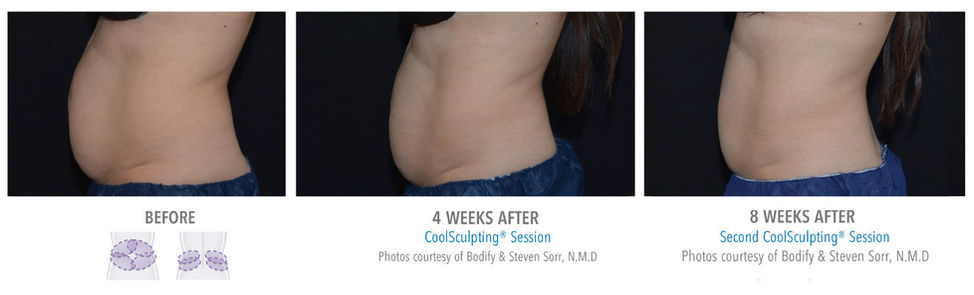 coolsculpting treatment upper abs