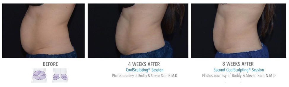 coolsculpting treatment upper abs